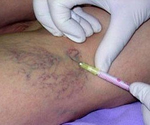 the varicose veins injection
