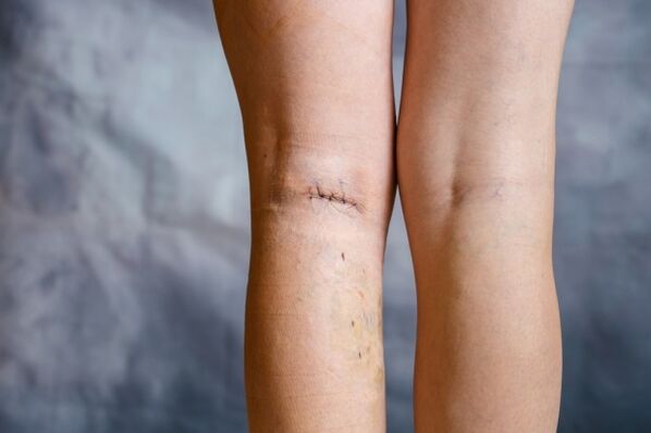 seam on leg after varicose vein surgery