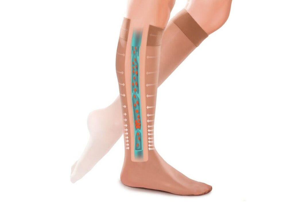 The effect of compression stockings on varicose veins