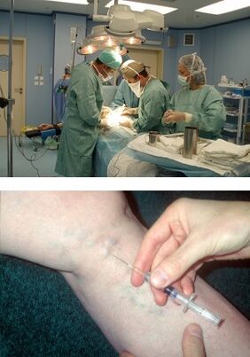 sclerotherapy to treat varicose veins