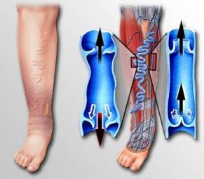 blood flow in legs with varicose veins