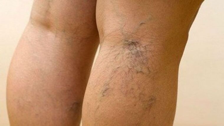 Varicose veins in legs