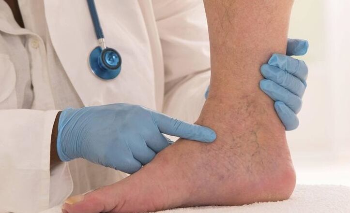 Doctor checking leg for varicose veins