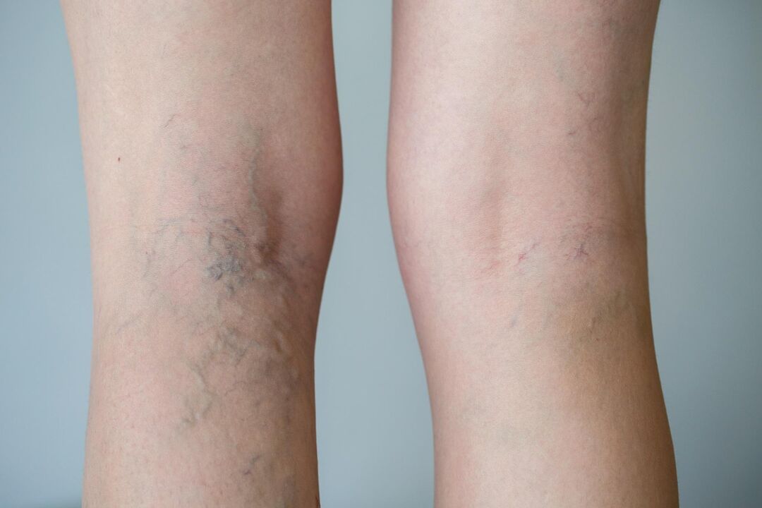 varicose veins in the legs photo 2