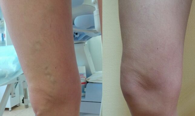 Legs before and after treatment for varicose veins