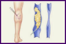 Sclerotherapy is a popular method for getting rid of varicose veins in the legs