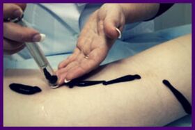 Treatment of varicose veins with leeches (hirudotherapy)