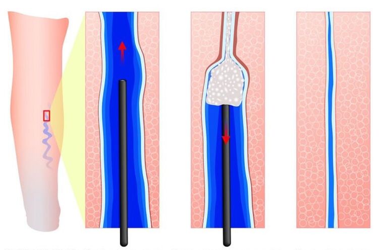 Treatment of varicose veins of the labia