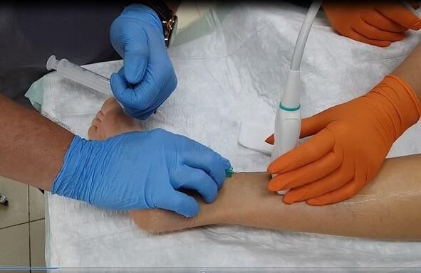 varicose veins therapy