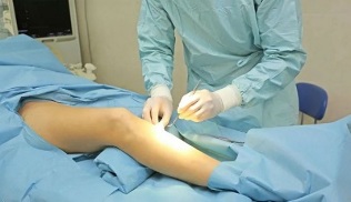How is surgery performed for varicose veins