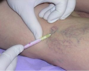 pain, varicose veins treatment fluid