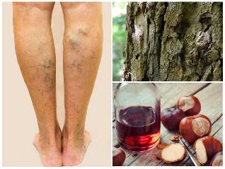 the vein treatment of the legs folk remedies