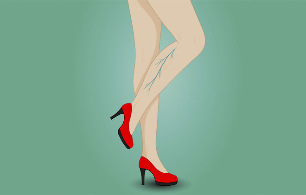 Varicose veins in women's legs