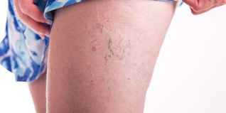 treatments for varicose veins