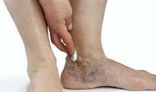 manifestation of varicose leg varicose veins