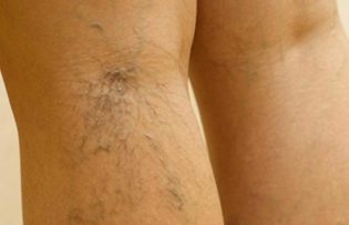 treatment of varicose veins, the legs,
