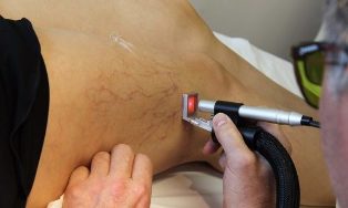 the varicose veins treatment, laser
