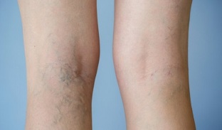 Signs of varicose leg veins in women