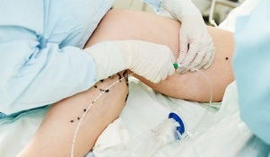 Treatments for varicose leg varicose veins in women