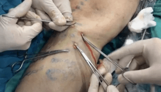 Varicose veinectomy is done to remove varicose veins