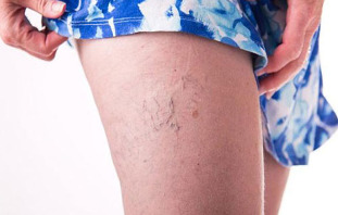 The varicose veins in the legs